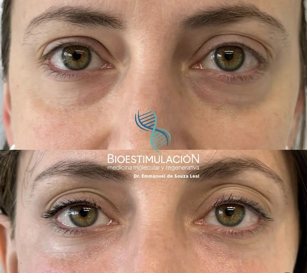 Tratamiento de Ojeras femenino - Bioestimulación